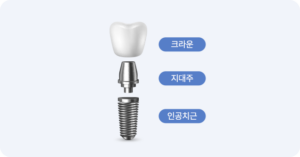 mo-임플란트구조