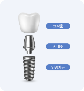임플란트 구조