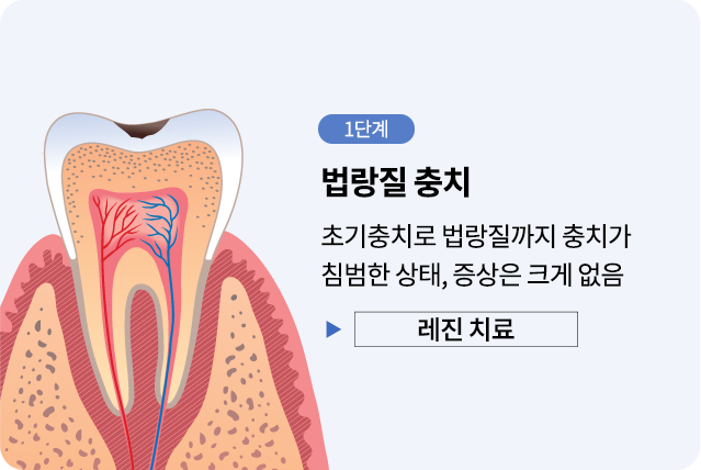 mo-충치진행단계01
