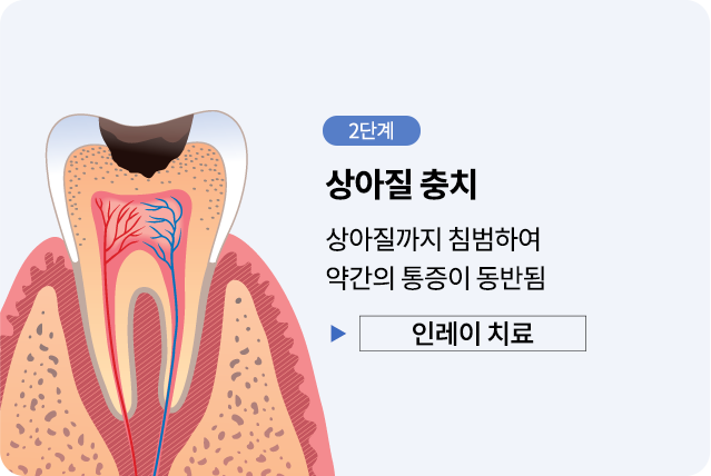 mo-충치진행단계02