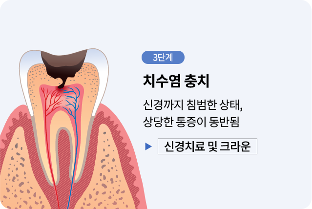 mo-충치진행단계03
