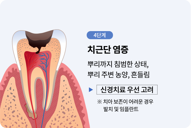 mo-충치진행단계04