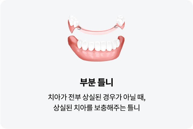 mo-틀니종류02