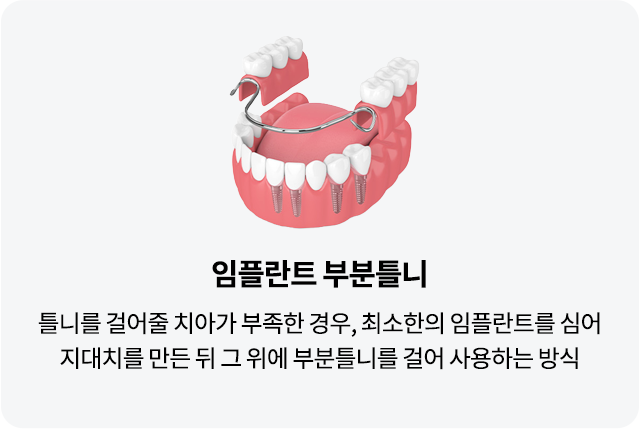 mo-틀니종류03