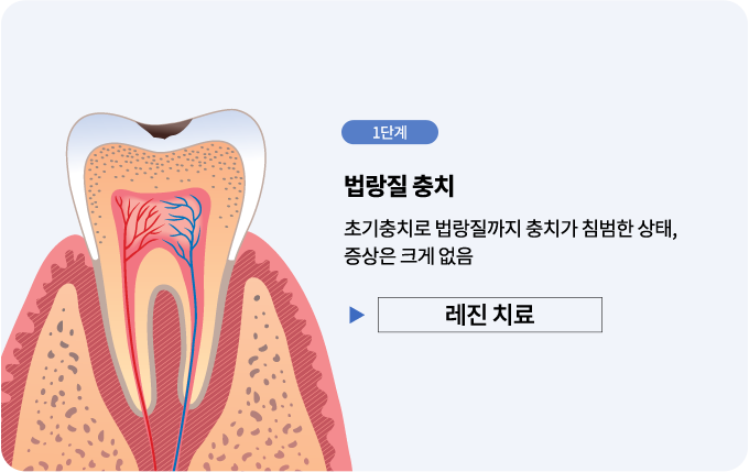 충치진료단계-레진치료