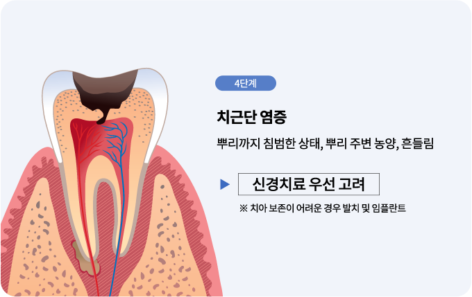 충치진행단계-신경치료