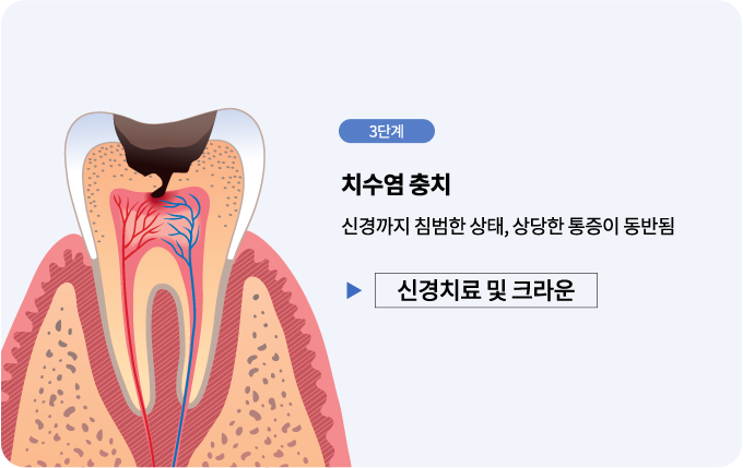 충치진행단계-신경치료및크라운