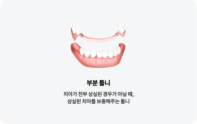 틀니종류-부분틀니