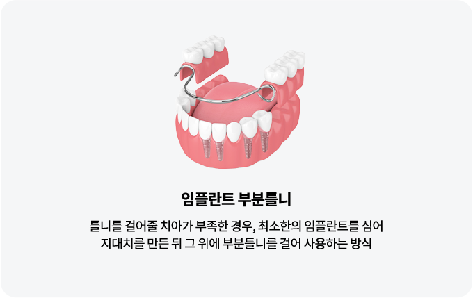 틀니종류-임플란트부분틀니