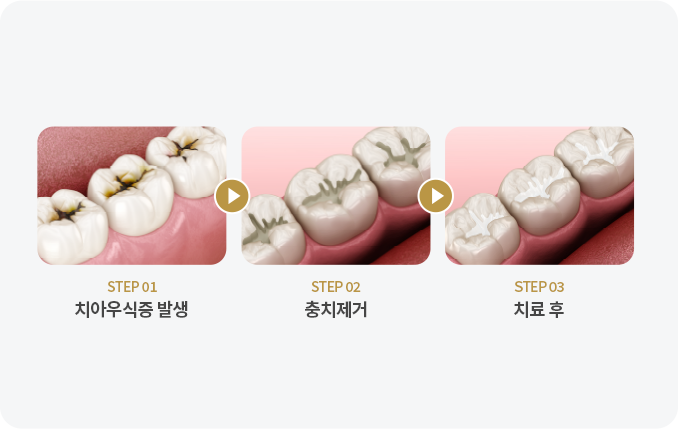충치치료단계01