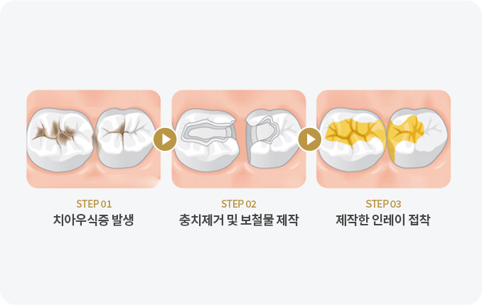 충치치료방법02