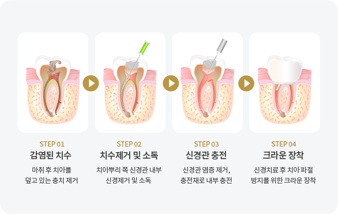 충치진행단계03